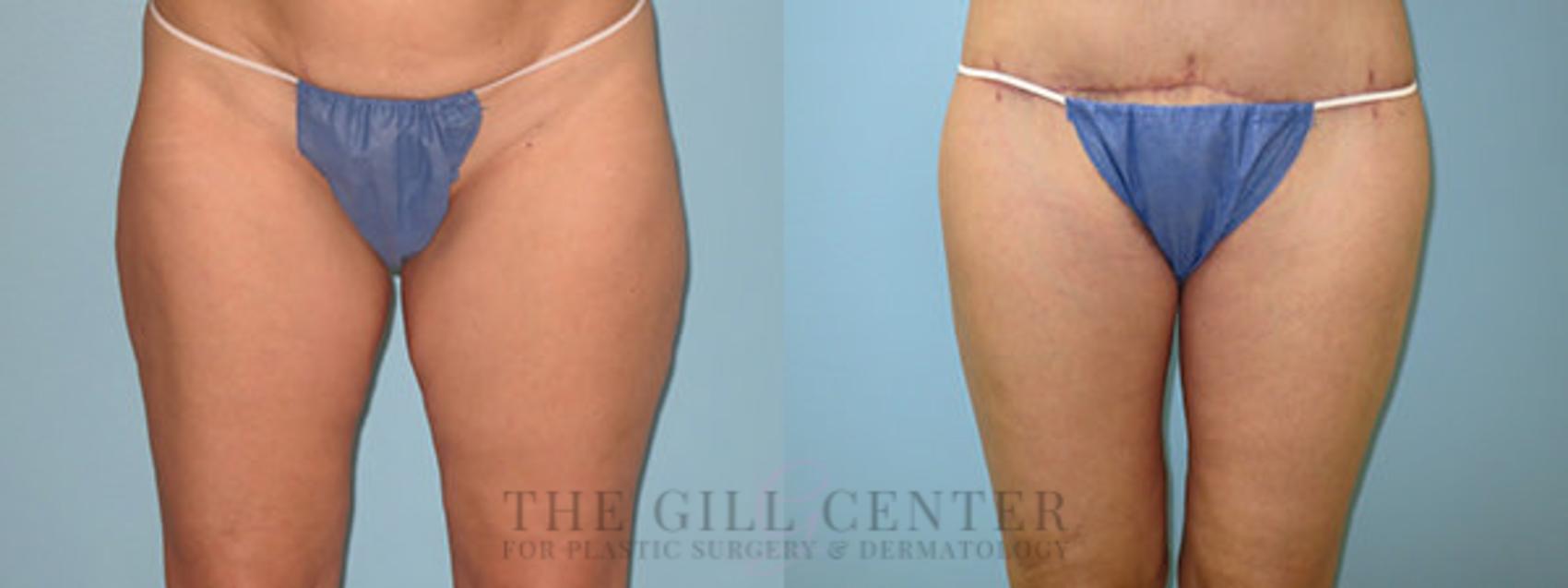 Thigh Lift Case 164 Before & After Front | The Woodlands, TX | The Gill Center for Plastic Surgery and Dermatology