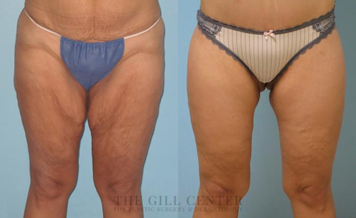 Thigh Lift Case 165 Before & After Front | The Woodlands, TX | The Gill Center for Plastic Surgery and Dermatology