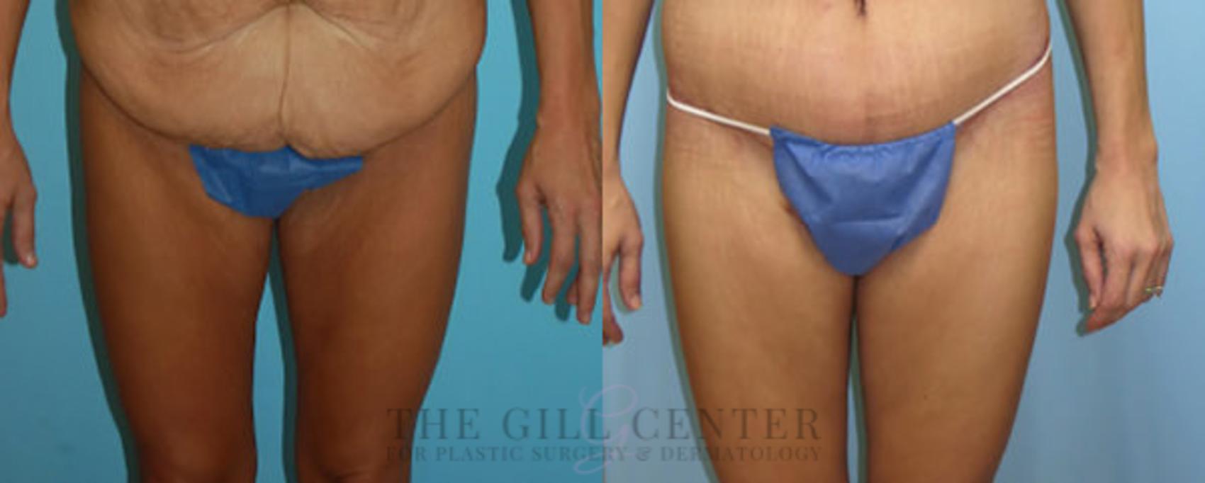 Thigh Lift Case 166 Before & After Front | The Woodlands, TX | The Gill Center for Plastic Surgery and Dermatology
