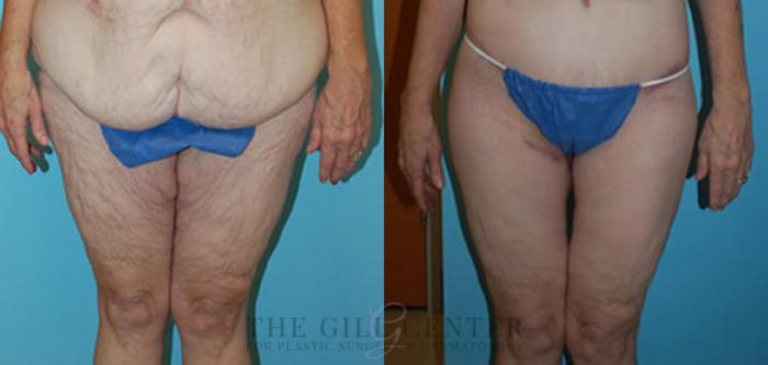 Thigh Lift Case 167 Before & After Front | The Woodlands, TX | The Gill Center for Plastic Surgery and Dermatology
