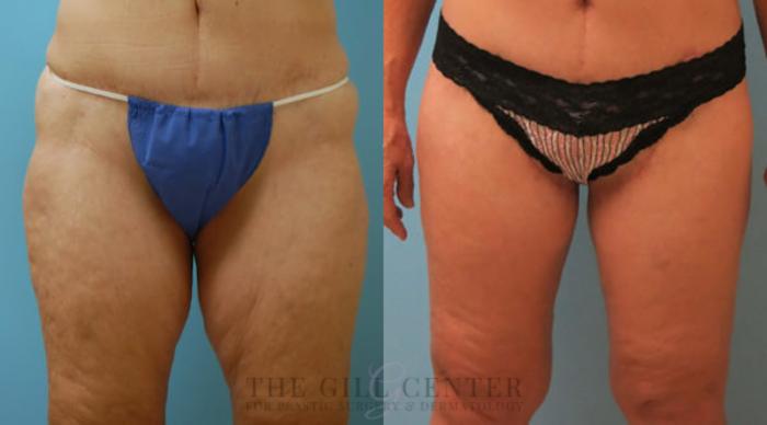Thigh Lift Case 168 Before & After Front | The Woodlands, TX | The Gill Center for Plastic Surgery and Dermatology