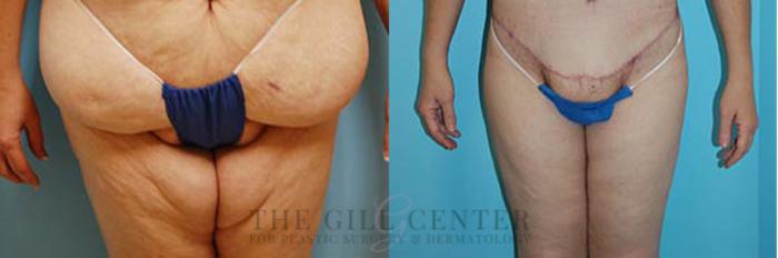 Thigh Lift Case 169 Before & After Front | The Woodlands, TX | The Gill Center for Plastic Surgery and Dermatology