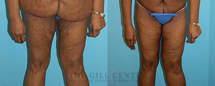 Thigh Lift Case 170 Before & After Front | The Woodlands, TX | The Gill Center for Plastic Surgery and Dermatology