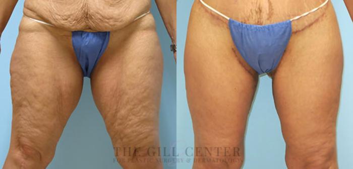Thigh Lift Case 172 Before & After Front | The Woodlands, TX | The Gill Center for Plastic Surgery and Dermatology