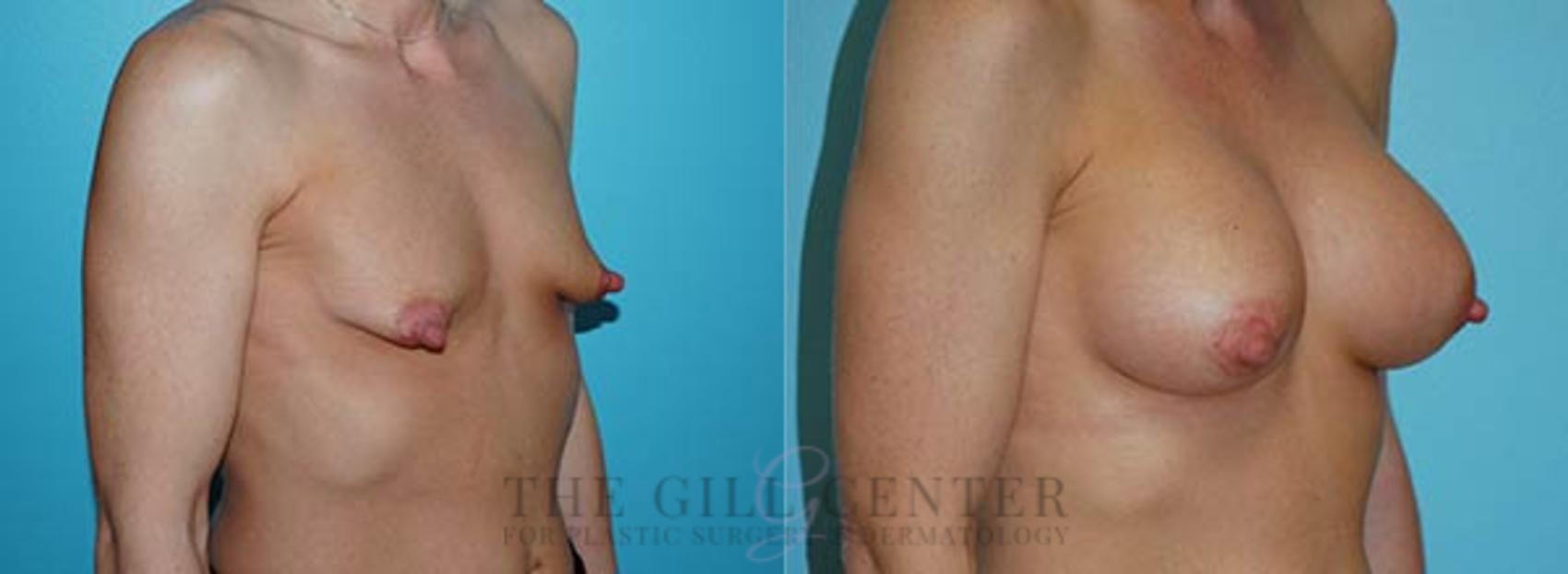 Tubular Breast Deformity Correction Case 358 Before & After Right Oblique | The Woodlands, TX | The Gill Center for Plastic Surgery and Dermatology