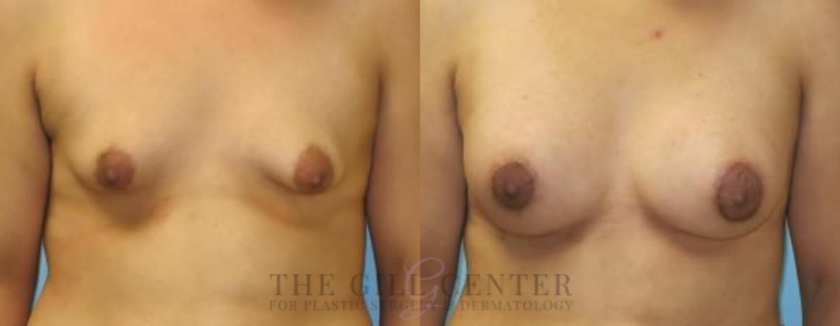 Tubular Breast Deformity Correction Case 359 Before & After Front | The Woodlands, TX | The Gill Center for Plastic Surgery and Dermatology
