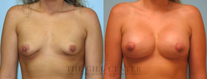 Tubular Breast Deformity Correction Case 360 Before & After Front | The Woodlands, TX | The Gill Center for Plastic Surgery and Dermatology