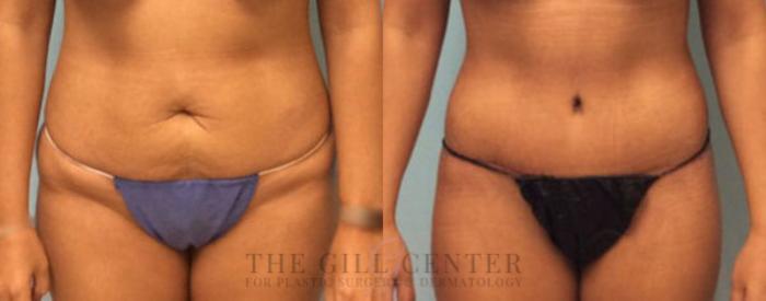 Tummy Tuck Case 175 Before & After Front | The Woodlands, TX | The Gill Center for Plastic Surgery and Dermatology