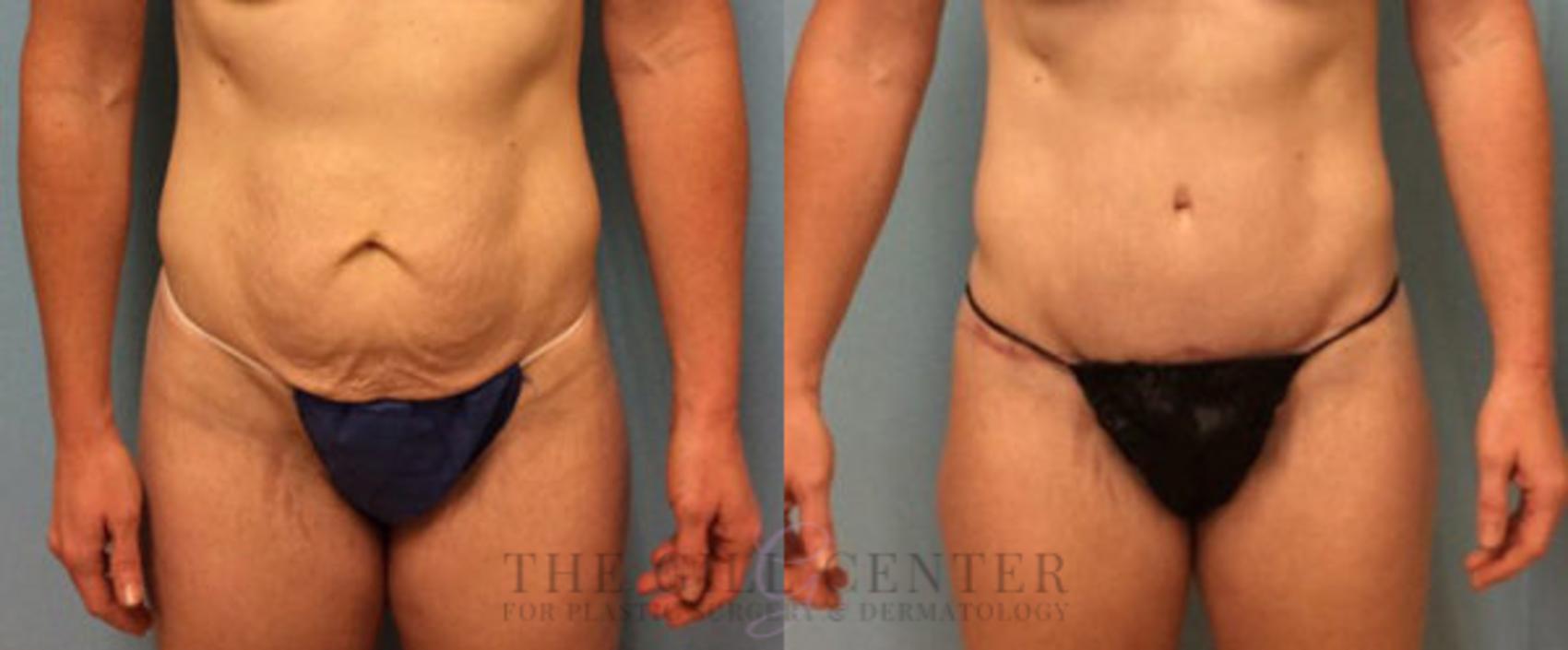 Tummy Tuck Case 178 Before & After Front | The Woodlands, TX | The Gill Center for Plastic Surgery and Dermatology