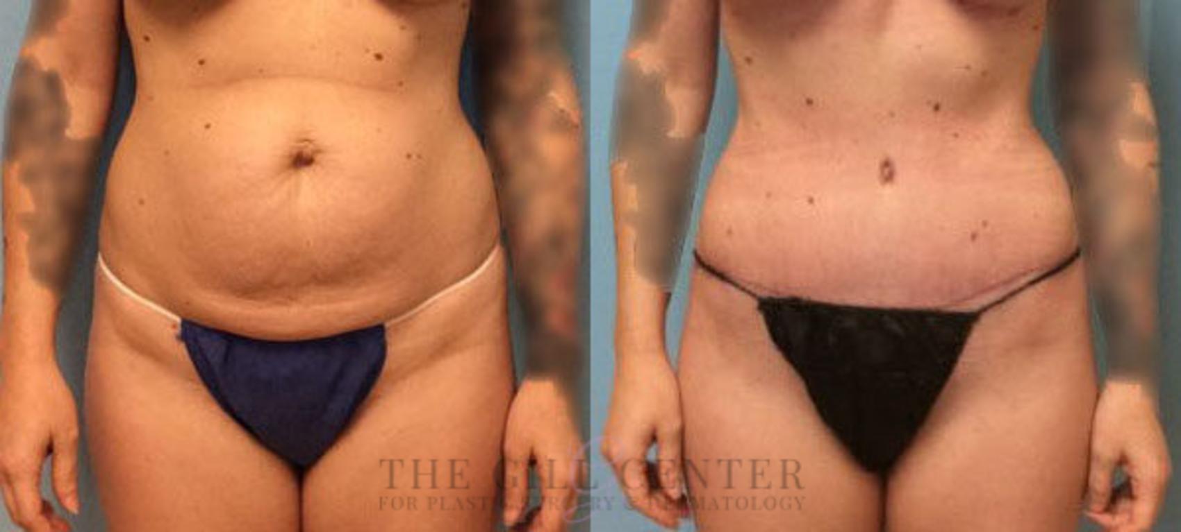 Tummy Tuck Case 179 Before & After Front | The Woodlands, TX | The Gill Center for Plastic Surgery and Dermatology