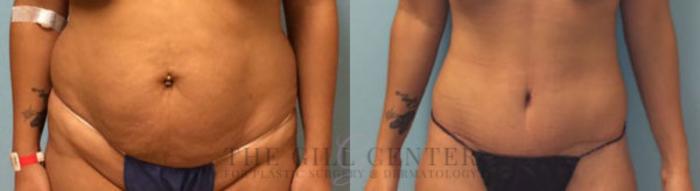 Tummy Tuck Case 180 Before & After Front | The Woodlands, TX | The Gill Center for Plastic Surgery and Dermatology