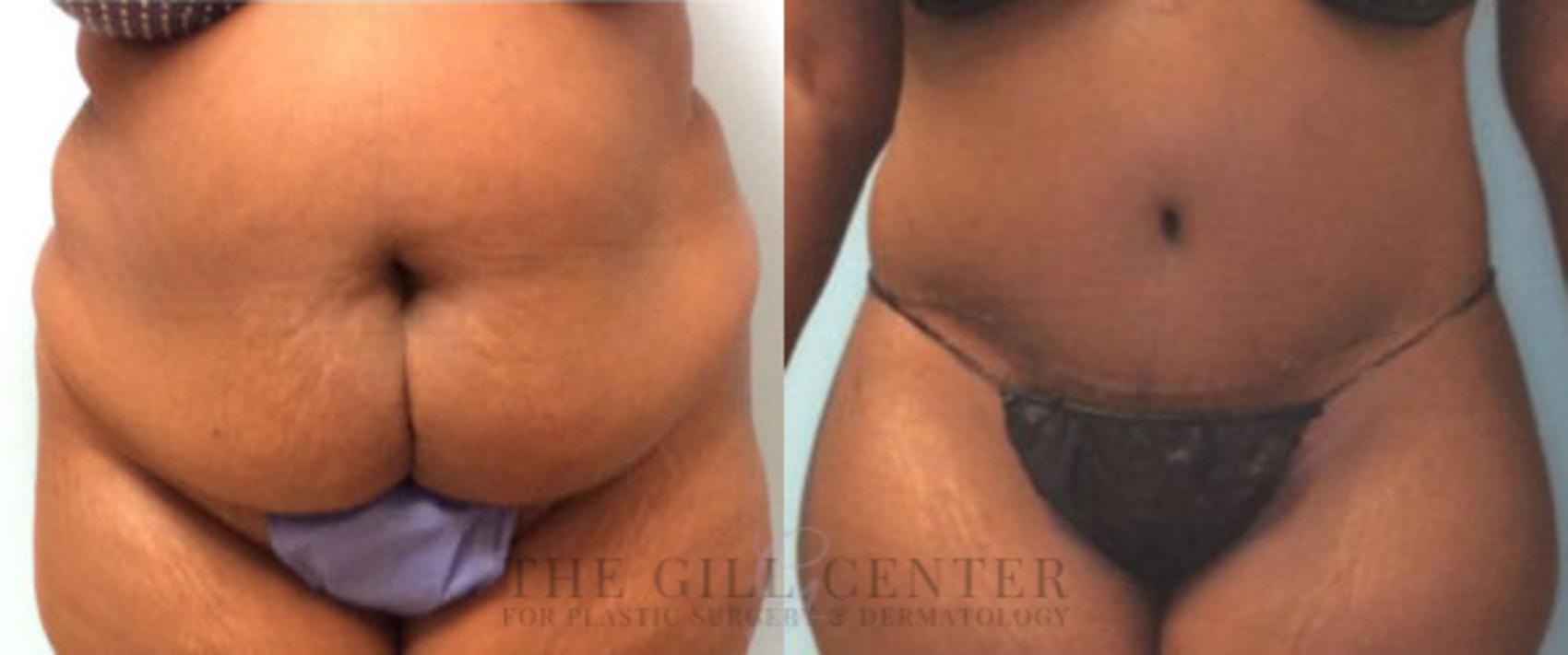 Tummy Tuck Case 181 Before & After Front | The Woodlands, TX | The Gill Center for Plastic Surgery and Dermatology