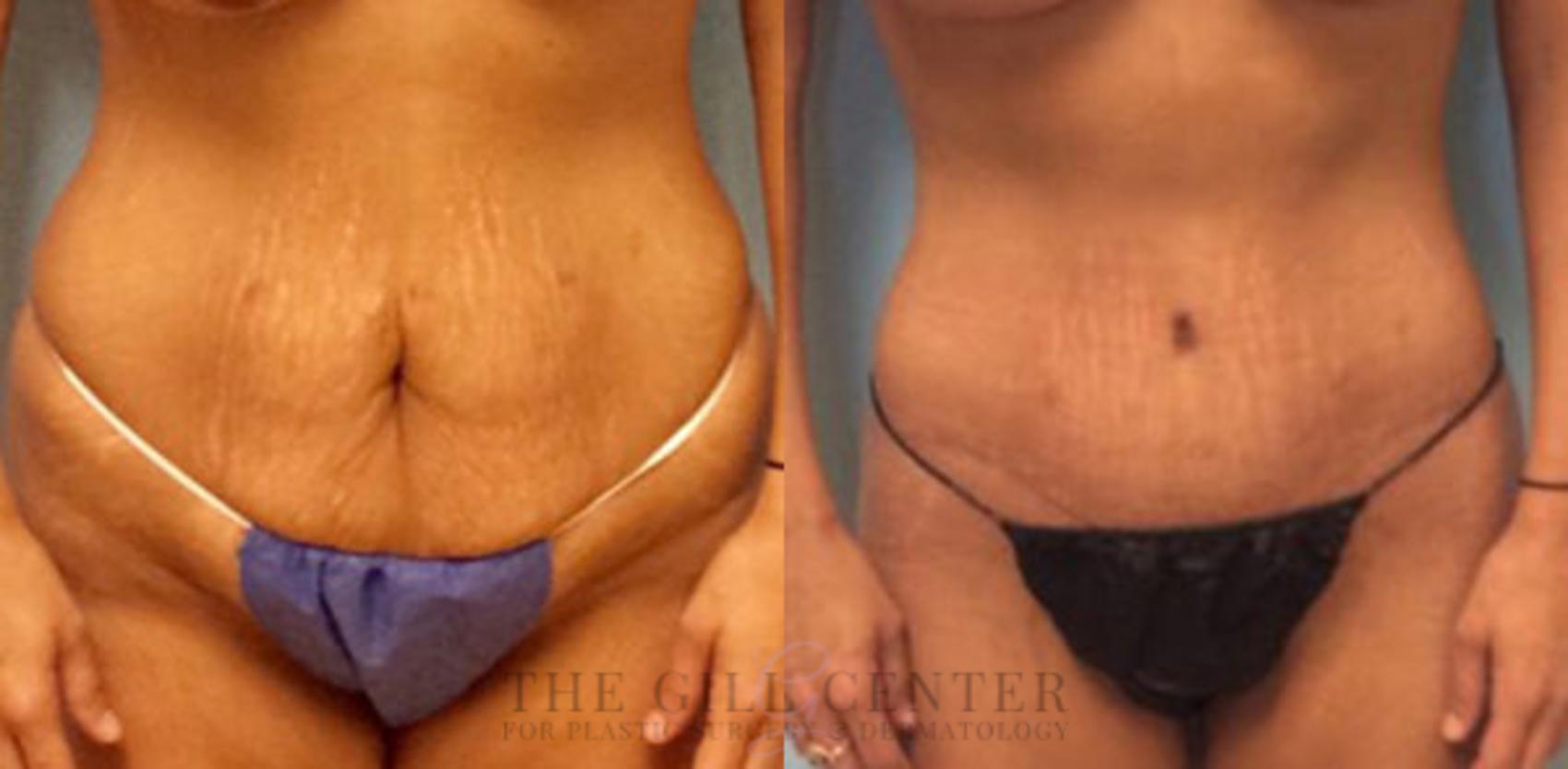 Tummy Tuck Case 182 Before & After Front | The Woodlands, TX | The Gill Center for Plastic Surgery and Dermatology