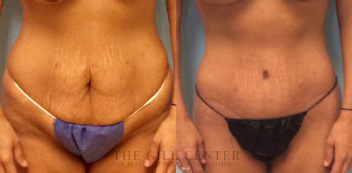 Tummy Tuck Case 182 Before & After Front | The Woodlands, TX | The Gill Center for Plastic Surgery and Dermatology