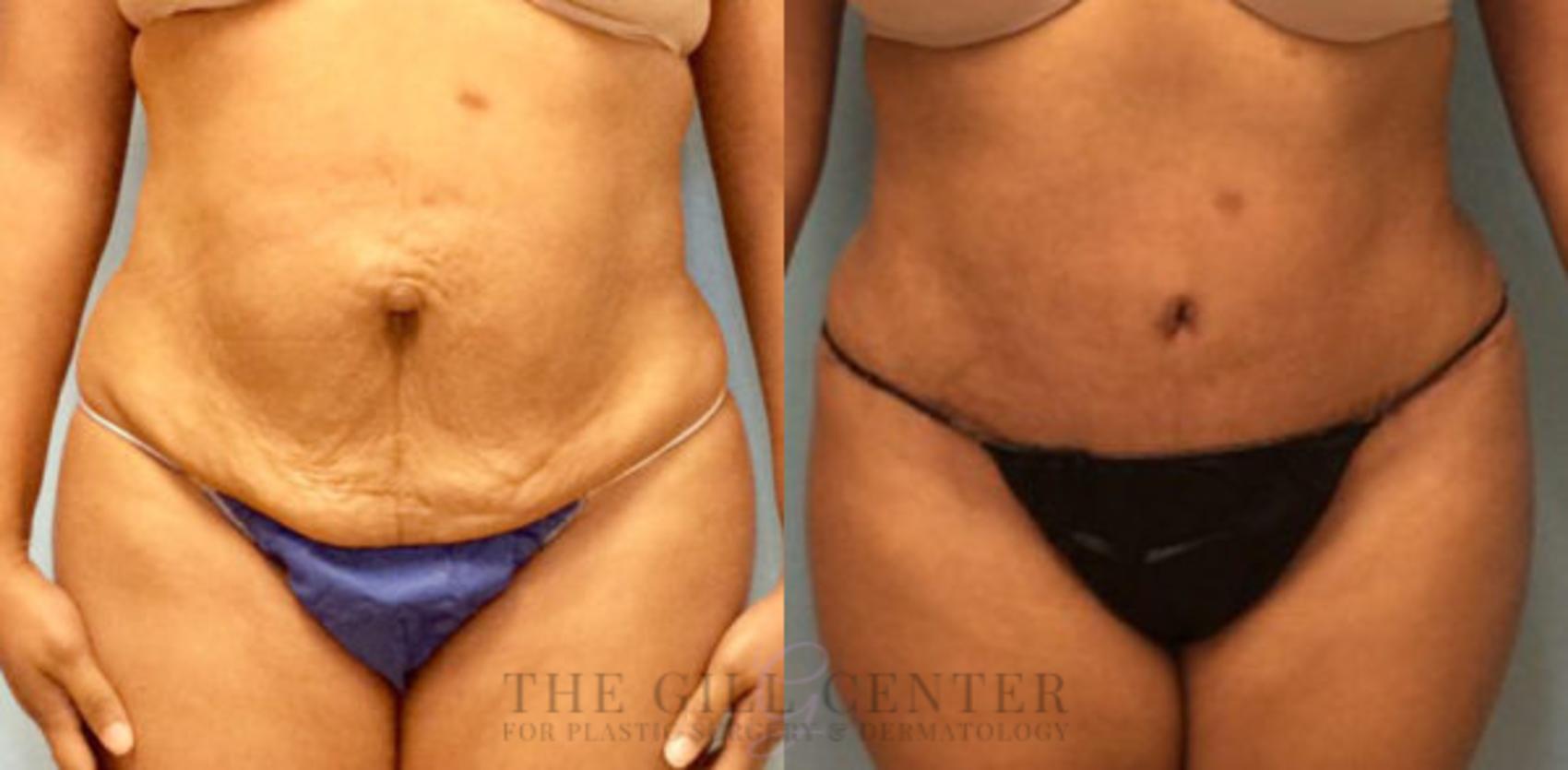 Tummy Tuck Case 183 Before & After Front | The Woodlands, TX | The Gill Center for Plastic Surgery and Dermatology