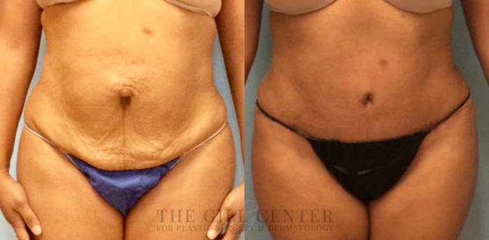 Tummy Tuck Case 183 Before & After Front | The Woodlands, TX | The Gill Center for Plastic Surgery and Dermatology