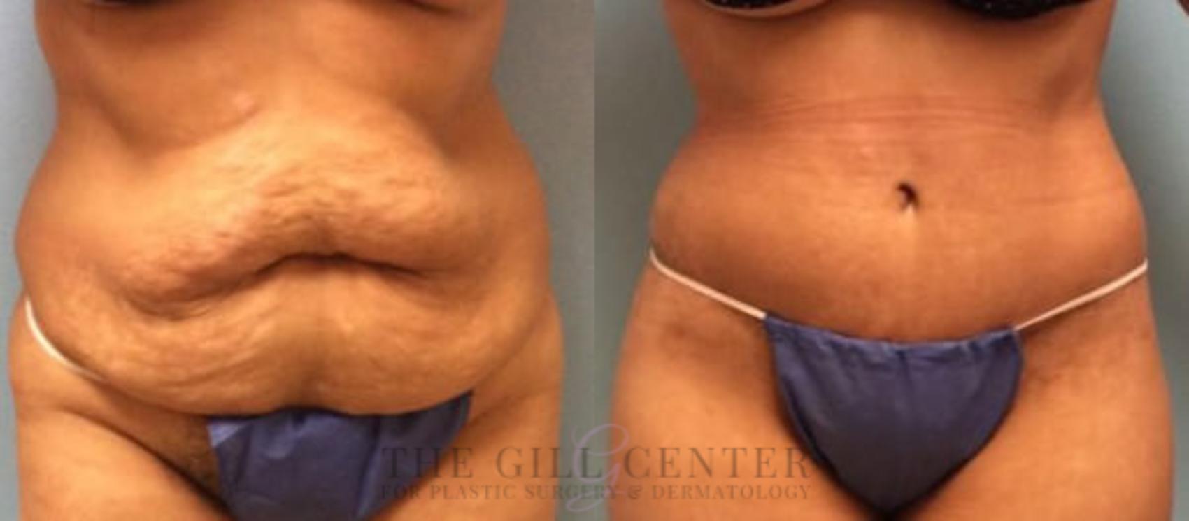 Tummy Tuck Case 185 Before & After Front | The Woodlands, TX | The Gill Center for Plastic Surgery and Dermatology