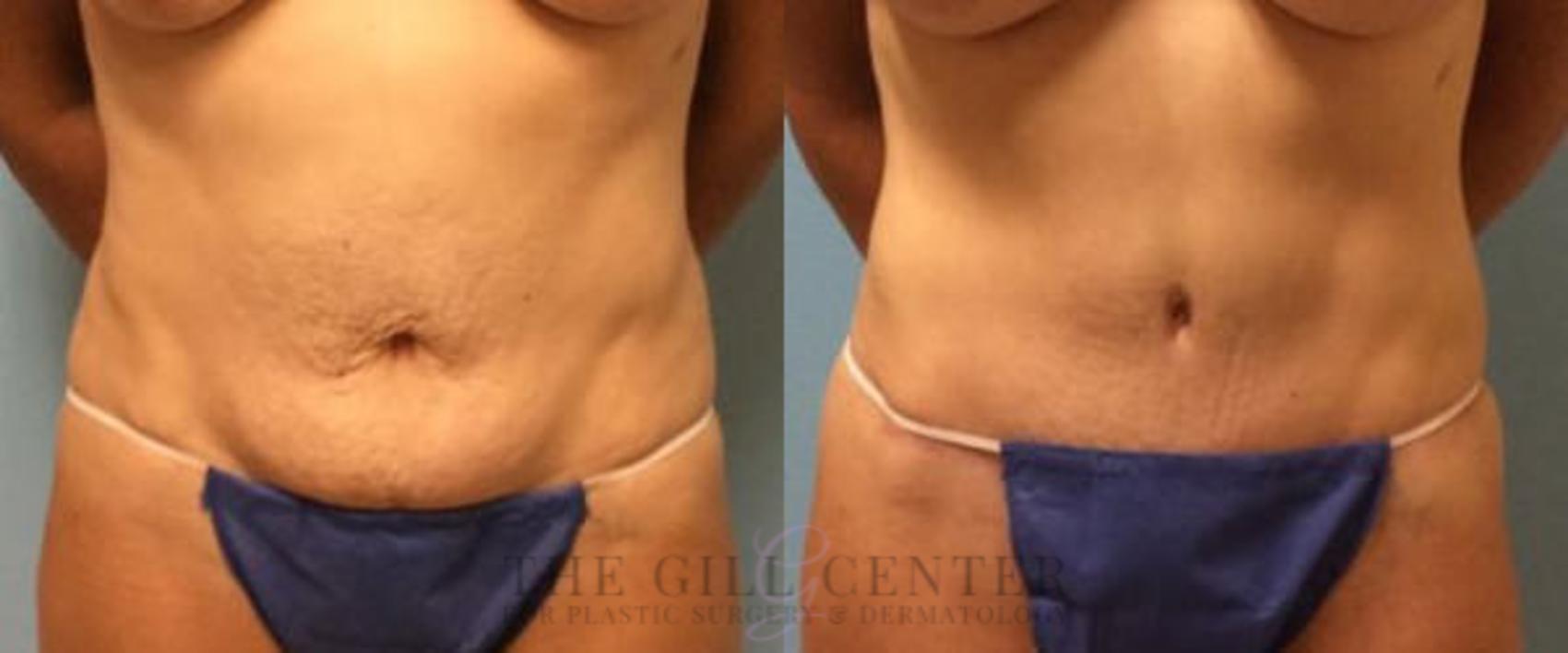 Tummy Tuck Case 187 Before & After Front | The Woodlands, TX | The Gill Center for Plastic Surgery and Dermatology