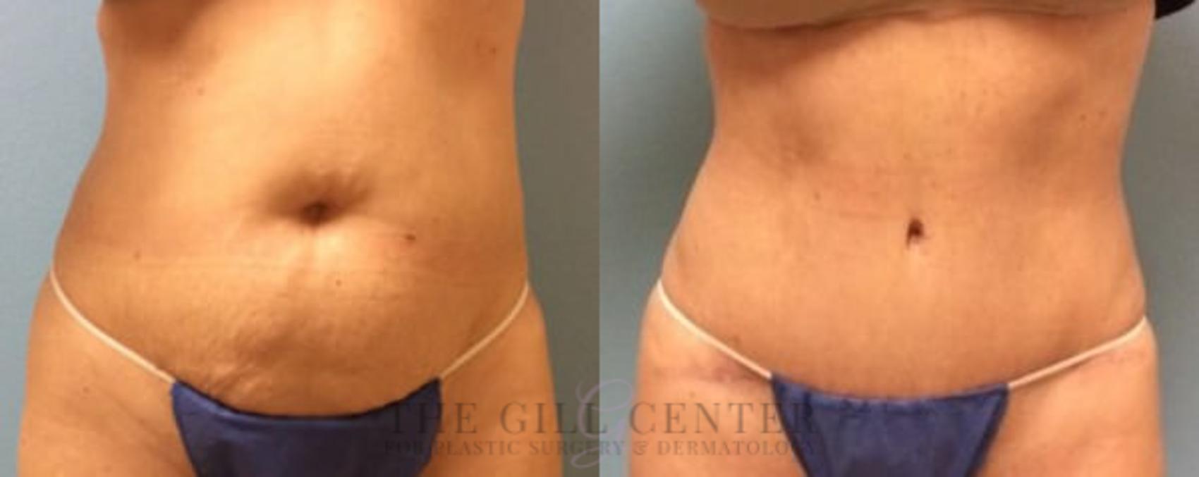 Tummy Tuck Case 188 Before & After Front | The Woodlands, TX | The Gill Center for Plastic Surgery and Dermatology