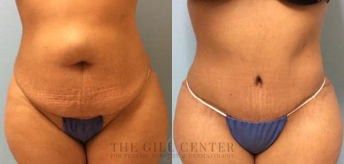 Tummy Tuck Case 189 Before & After Front | The Woodlands, TX | The Gill Center for Plastic Surgery and Dermatology