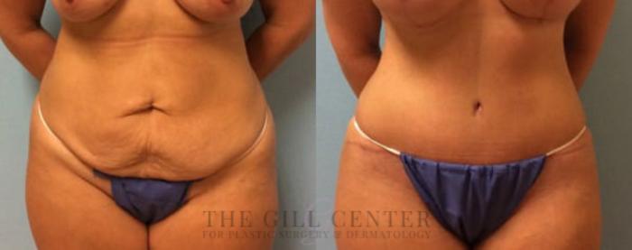 Tummy Tuck Case 191 Before & After Front | The Woodlands, TX | The Gill Center for Plastic Surgery and Dermatology