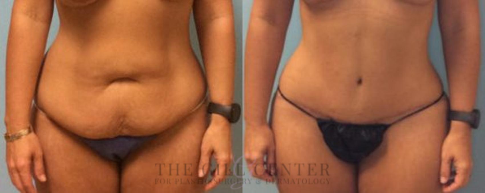 Tummy Tuck Case 192 Before & After Front | The Woodlands, TX | The Gill Center for Plastic Surgery and Dermatology