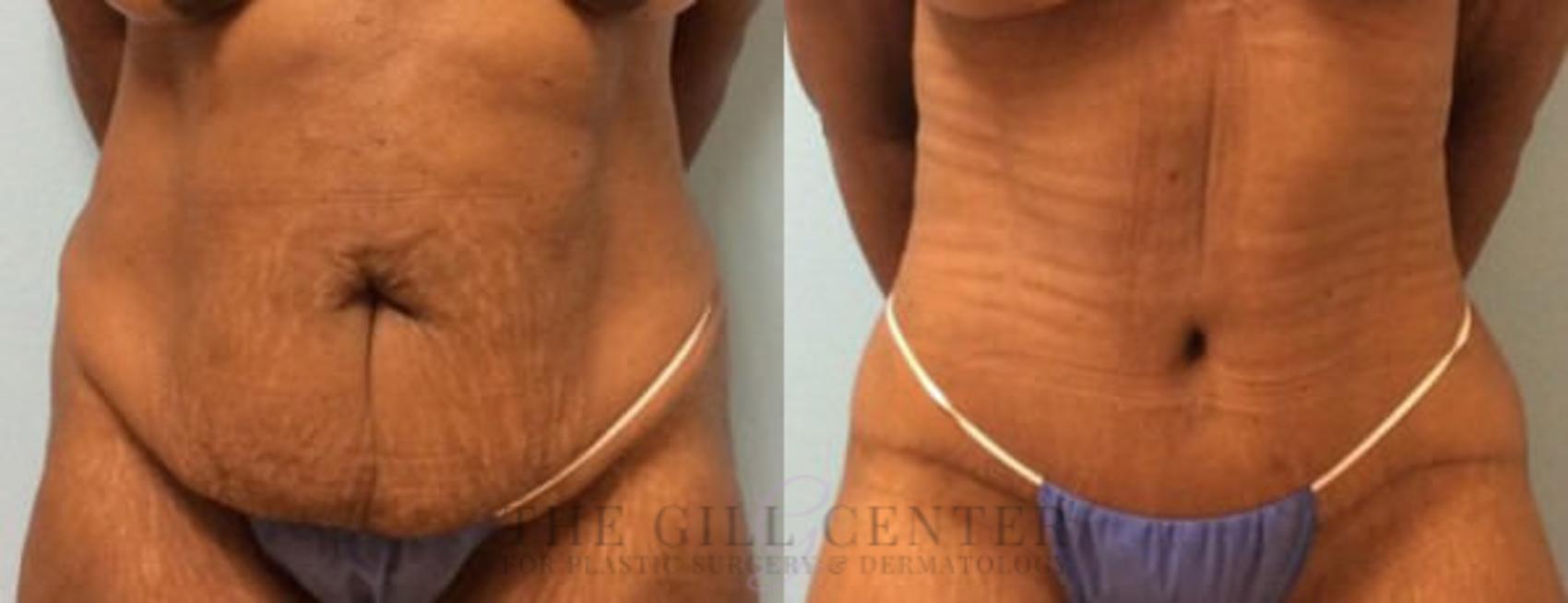 Tummy Tuck Case 194 Before & After Front | The Woodlands, TX | The Gill Center for Plastic Surgery and Dermatology