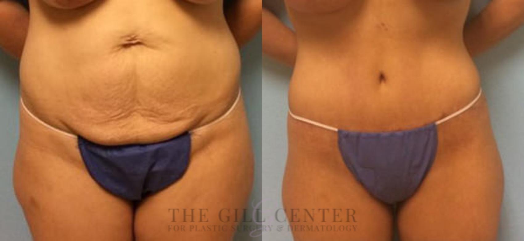 Tummy Tuck Case 195 Before & After Front | The Woodlands, TX | The Gill Center for Plastic Surgery and Dermatology