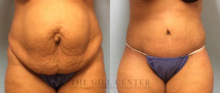 Tummy Tuck Case 196 Before & After Front | The Woodlands, TX | The Gill Center for Plastic Surgery and Dermatology