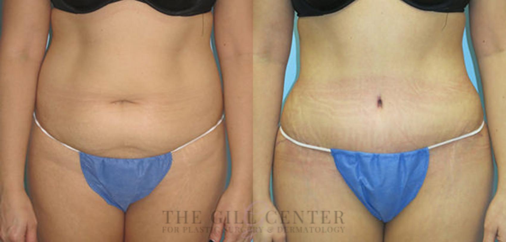 Tummy Tuck Case 199 Before & After Front | The Woodlands, TX | The Gill Center for Plastic Surgery and Dermatology