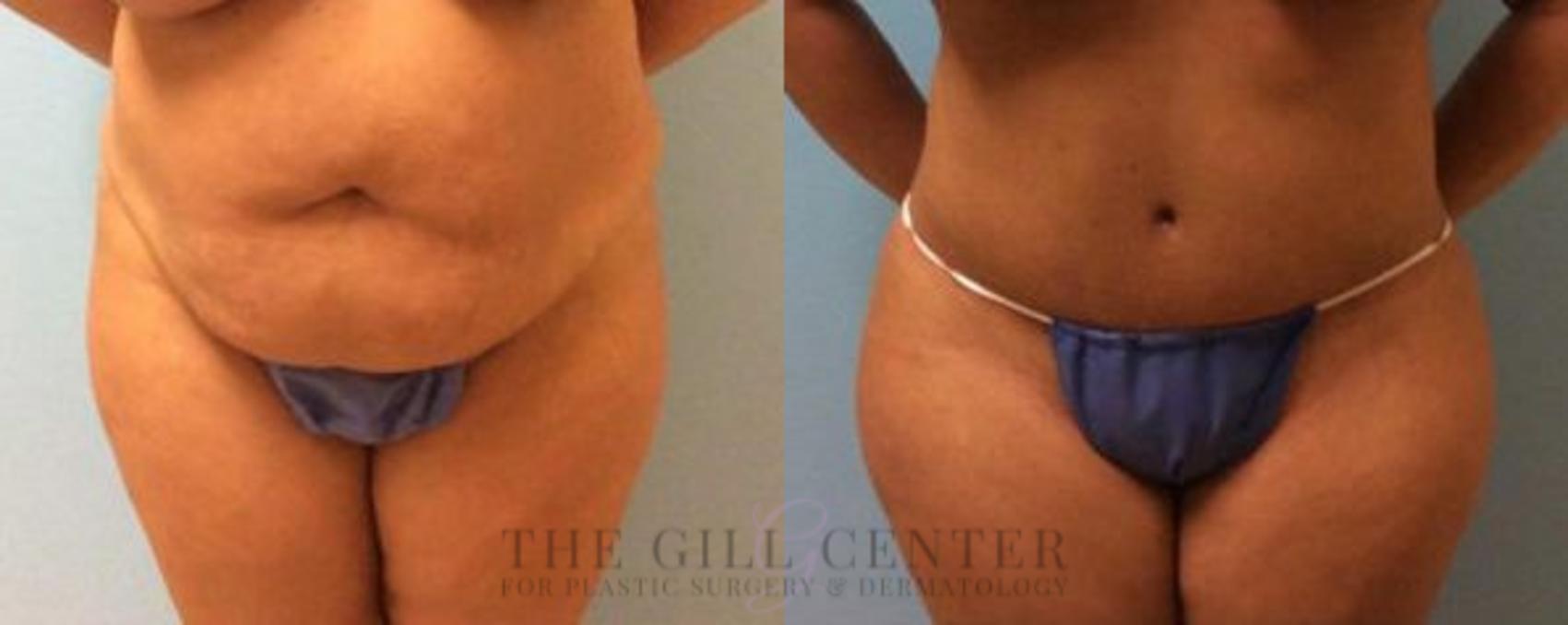 Tummy Tuck Case 200 Before & After Front | The Woodlands, TX | The Gill Center for Plastic Surgery and Dermatology