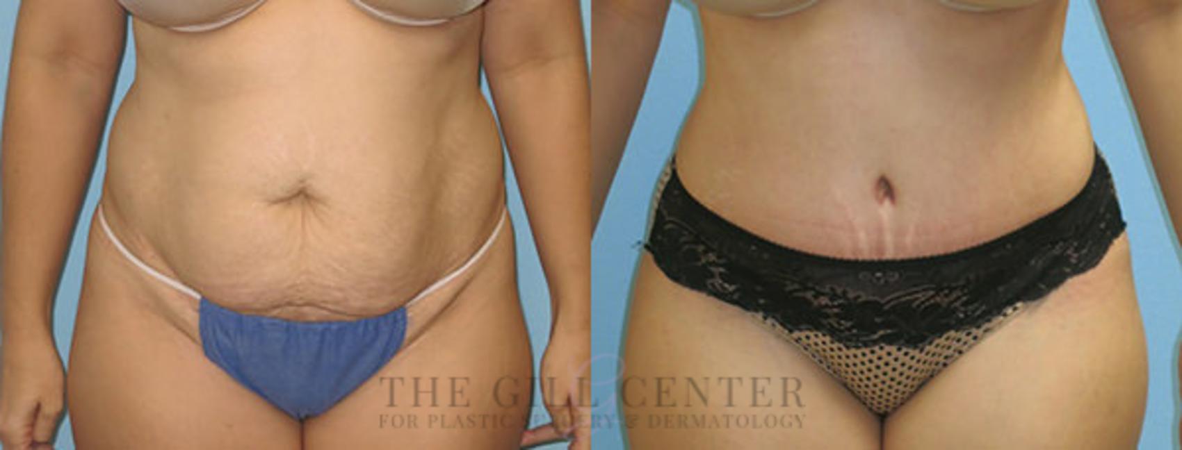 Tummy Tuck Case 209 Before & After Front | The Woodlands, TX | The Gill Center for Plastic Surgery and Dermatology