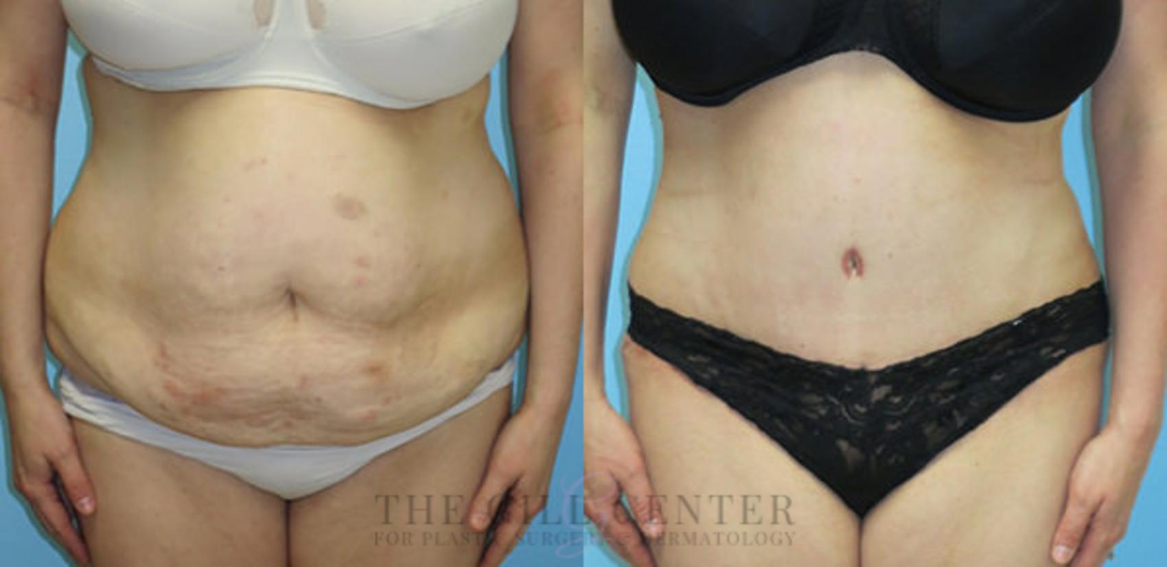 Tummy Tuck Case 212 Before & After Front | The Woodlands, TX | The Gill Center for Plastic Surgery and Dermatology