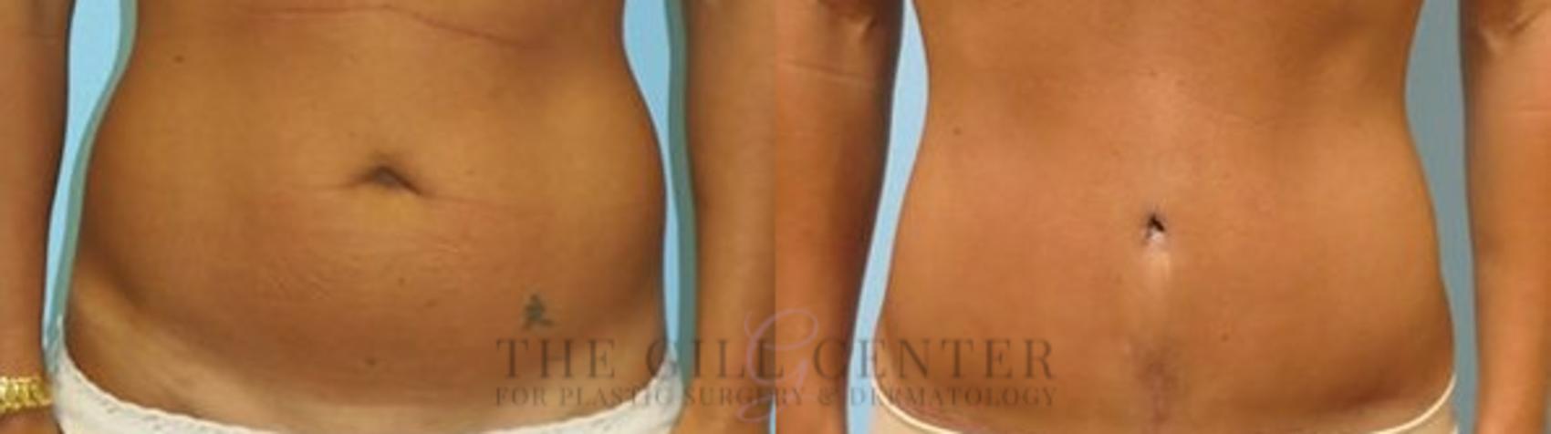 Tummy Tuck Case 214 Before & After Front | The Woodlands, TX | The Gill Center for Plastic Surgery and Dermatology