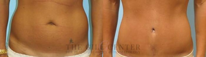 Tummy Tuck Case 214 Before & After Front | The Woodlands, TX | The Gill Center for Plastic Surgery and Dermatology