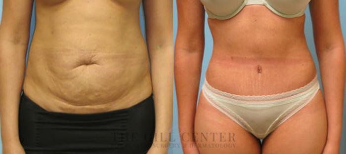Tummy Tuck Case 215 Before & After Front | The Woodlands, TX | The Gill Center for Plastic Surgery and Dermatology