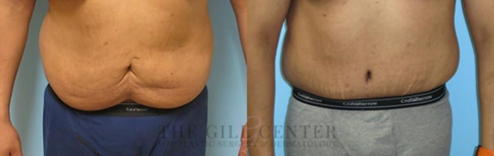 Tummy Tuck Case 216 Before & After Front | The Woodlands, TX | The Gill Center for Plastic Surgery and Dermatology