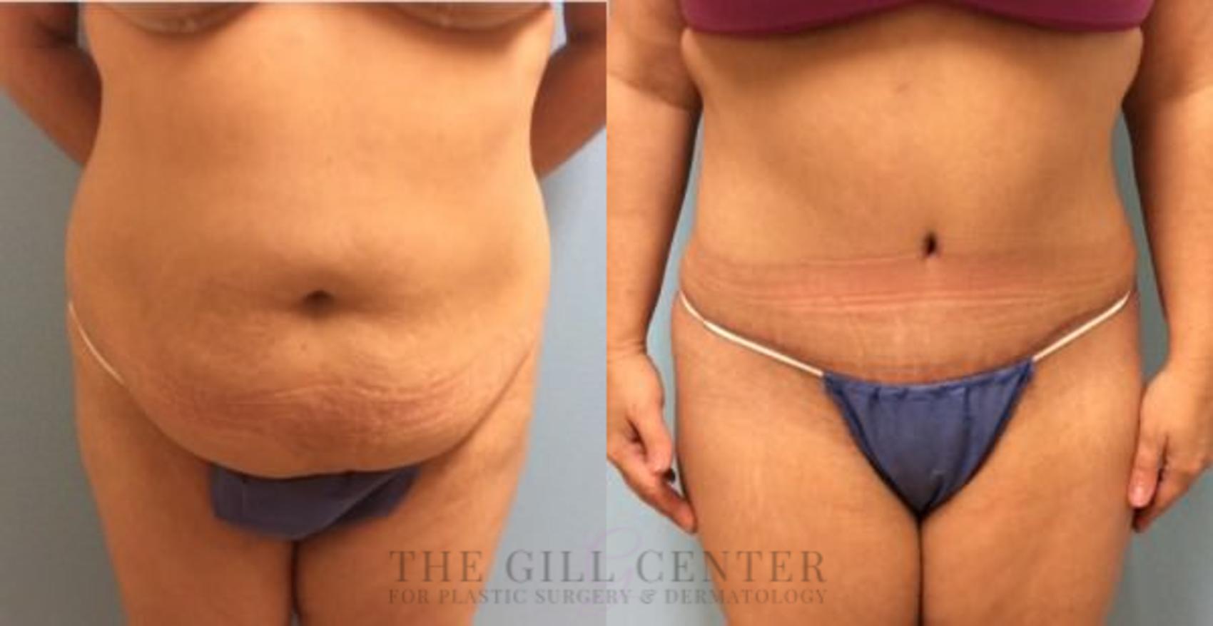 Tummy Tuck Case 217 Before & After Front | The Woodlands, TX | The Gill Center for Plastic Surgery and Dermatology