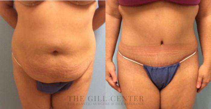 Tummy Tuck Case 217 Before & After Front | The Woodlands, TX | The Gill Center for Plastic Surgery and Dermatology