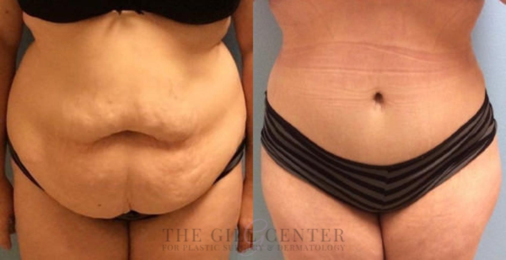 Tummy Tuck Case 219 Before & After Front | The Woodlands, TX | The Gill Center for Plastic Surgery and Dermatology