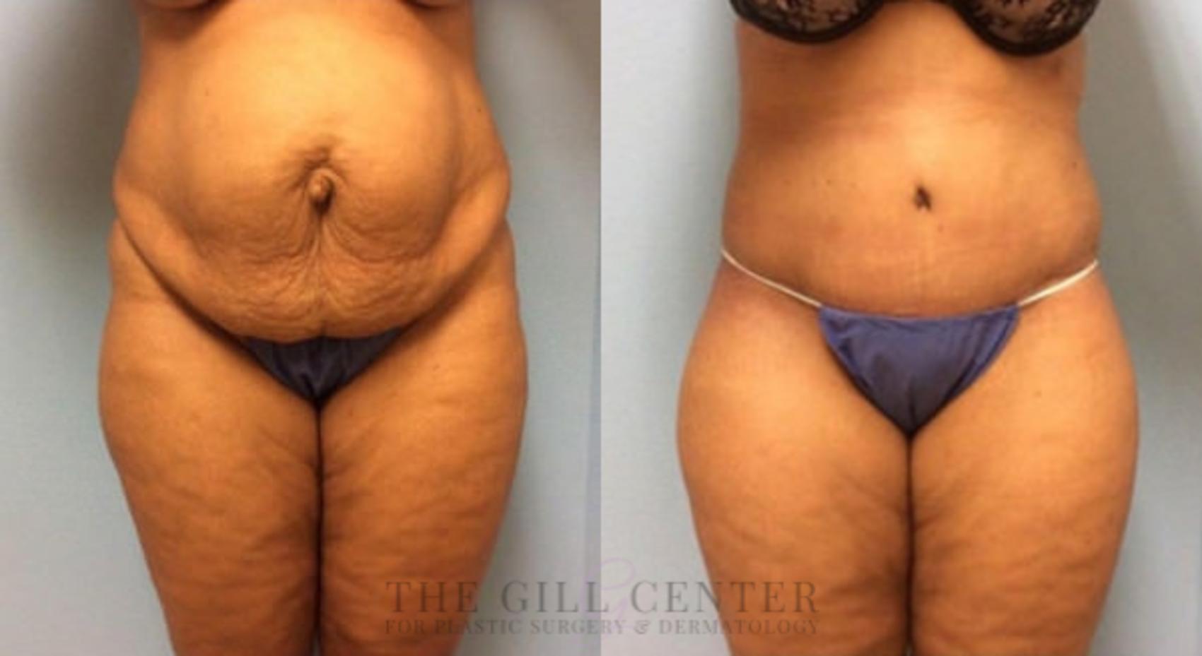 Tummy Tuck Case 221 Before & After Front | The Woodlands, TX | The Gill Center for Plastic Surgery and Dermatology