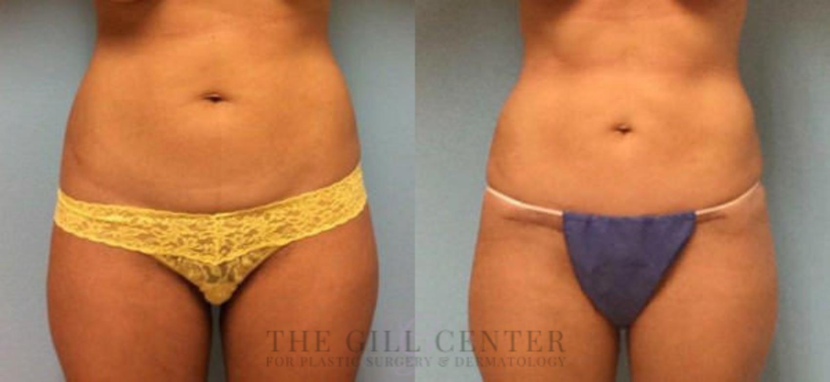 Tummy Tuck Case 222 Before & After Front | The Woodlands, TX | The Gill Center for Plastic Surgery and Dermatology