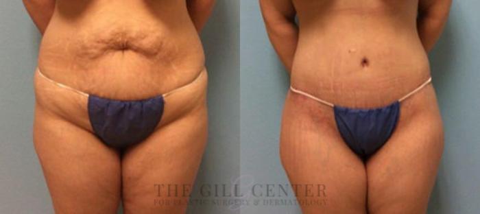 Tummy Tuck Case 223 Before & After Front | The Woodlands, TX | The Gill Center for Plastic Surgery and Dermatology