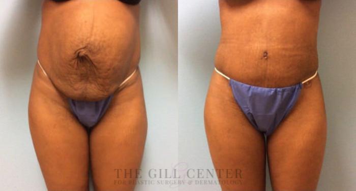 Tummy Tuck Case 224 Before & After Front | The Woodlands, TX | The Gill Center for Plastic Surgery and Dermatology