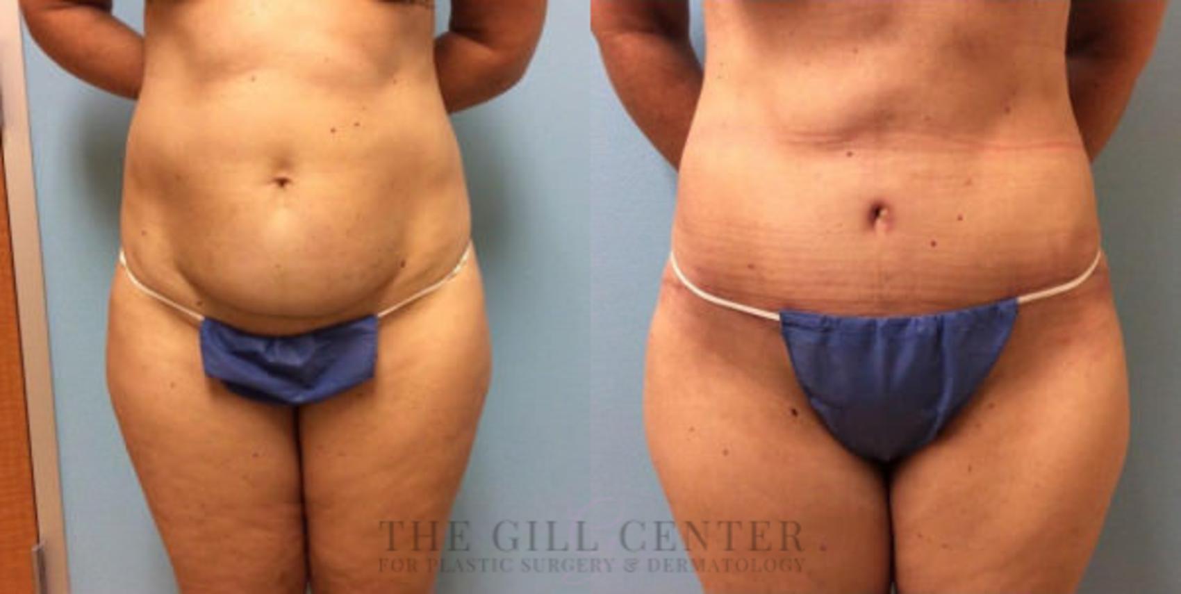 Tummy Tuck Case 225 Before & After Front | The Woodlands, TX | The Gill Center for Plastic Surgery and Dermatology