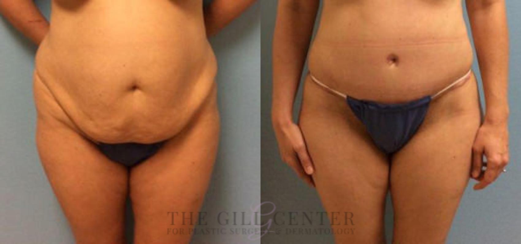 Tummy Tuck Case 226 Before & After Front | The Woodlands, TX | The Gill Center for Plastic Surgery and Dermatology