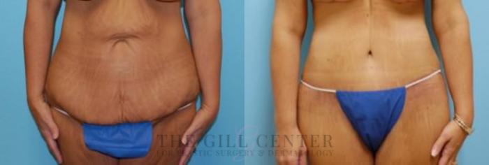 Tummy Tuck Case 227 Before & After Front | The Woodlands, TX | The Gill Center for Plastic Surgery and Dermatology