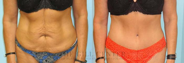 Tummy Tuck Case 228 Before & After Front | The Woodlands, TX | The Gill Center for Plastic Surgery and Dermatology