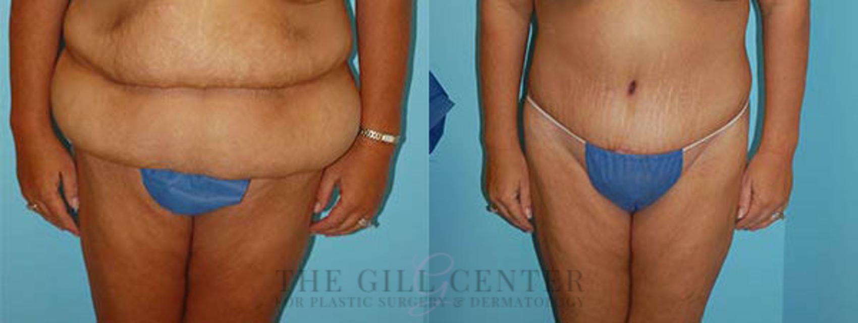 Tummy Tuck Case 229 Before & After Front | The Woodlands, TX | The Gill Center for Plastic Surgery and Dermatology