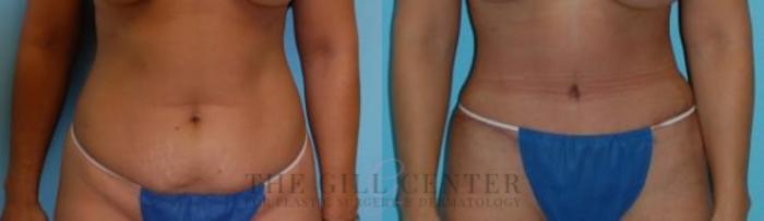 Tummy Tuck Case 230 Before & After Front | The Woodlands, TX | The Gill Center for Plastic Surgery and Dermatology